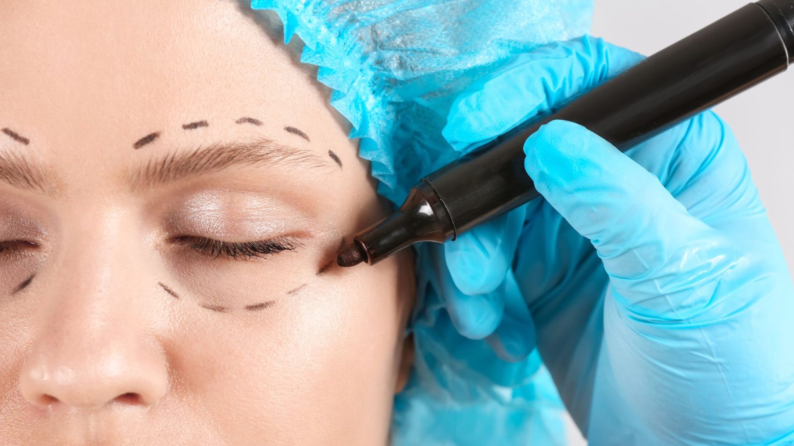 Tratamiento de blefaroplastia sin cirugía en Zaragoza