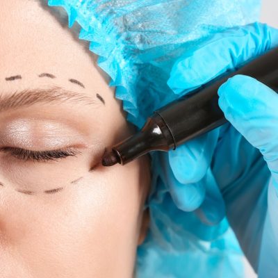 Blefaroplastia sin cirugía: alternativas, resultados y limitaciones